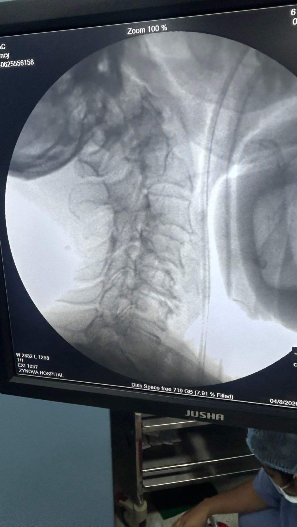 Spinal Cord Stimulation for Chronic Pain: A Modern Approach to Pain Relief